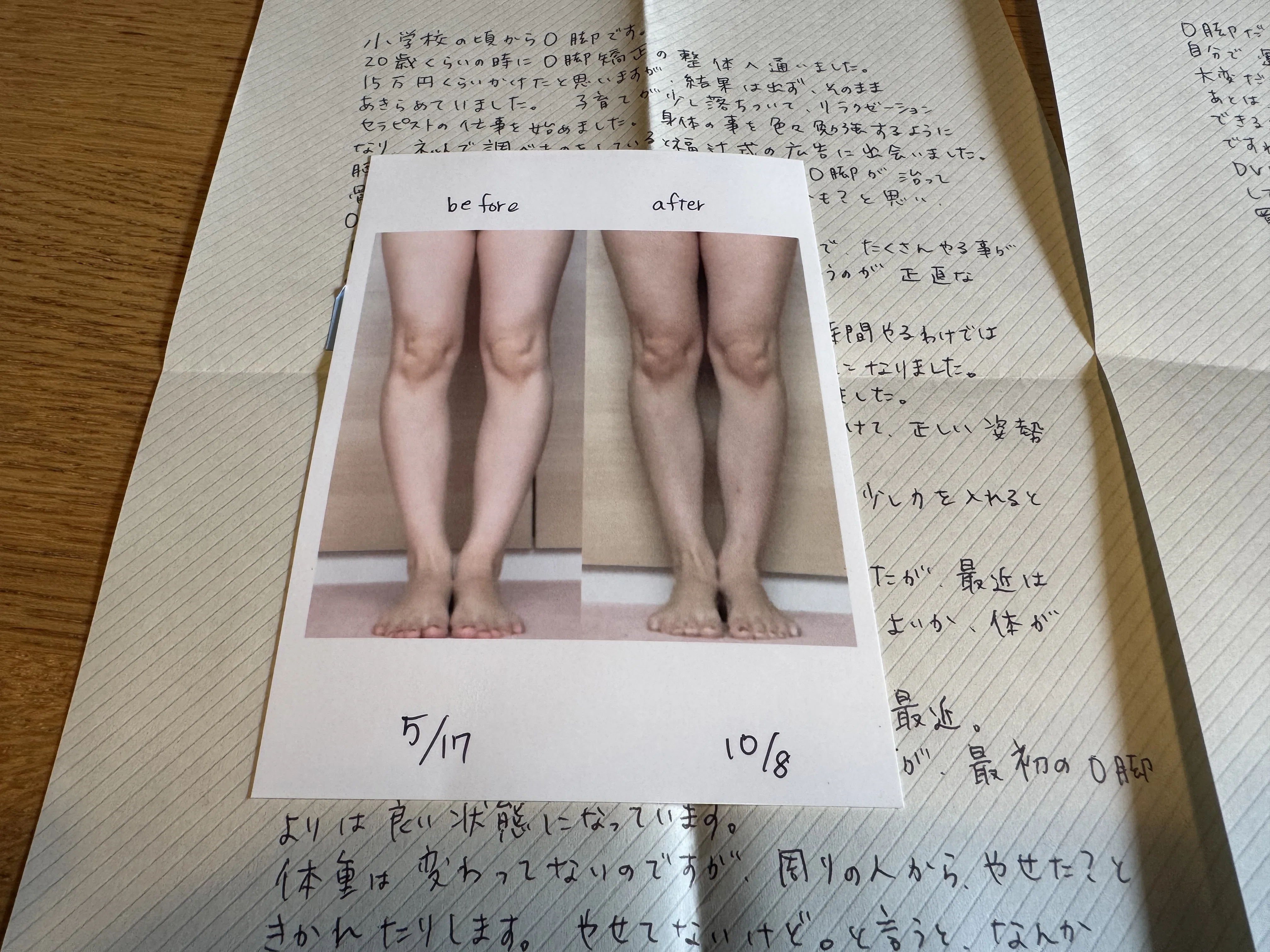O脚「小学校の頃からO脚です。20歳位の時にO脚矯正の整体へ通いました