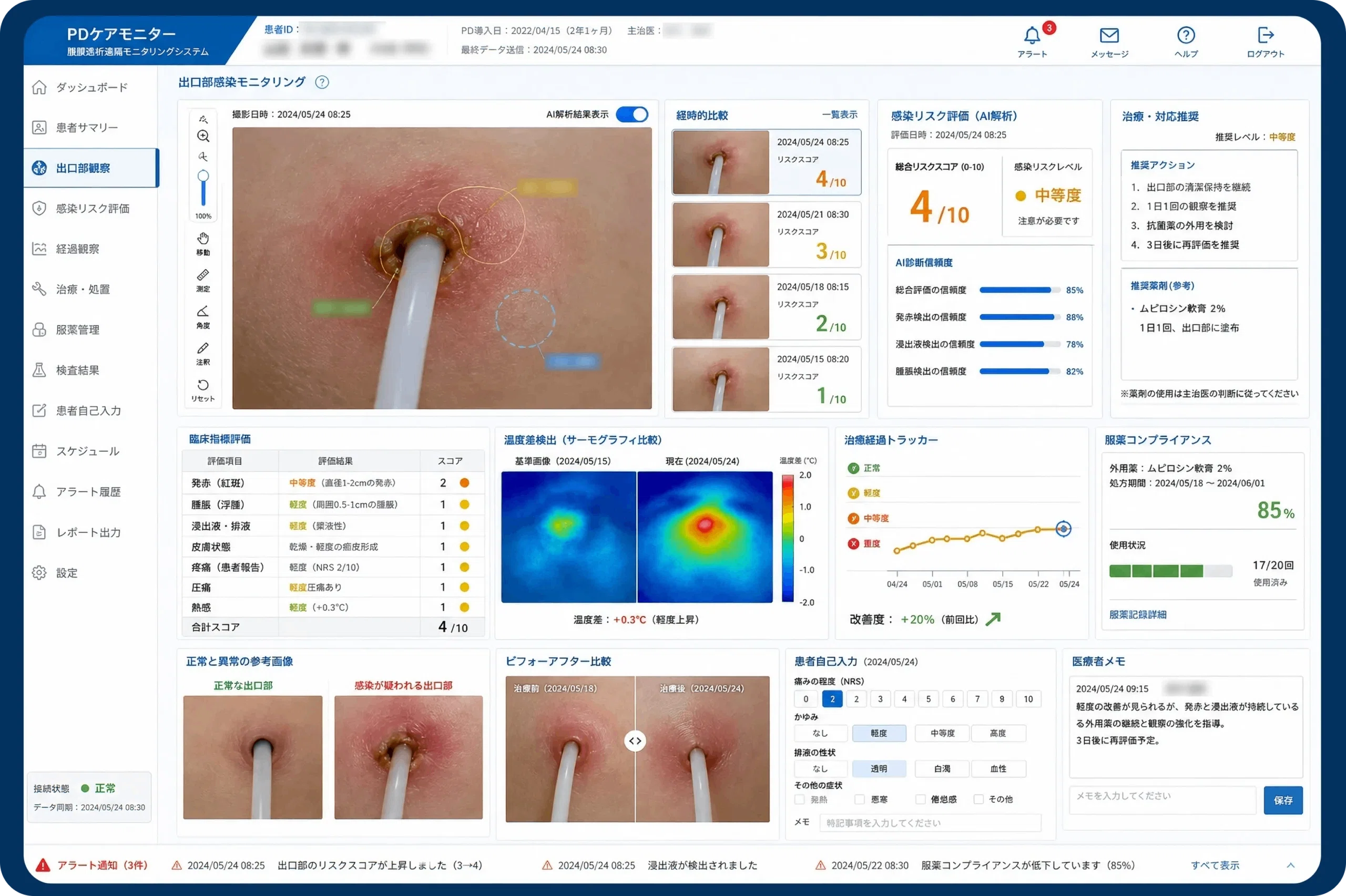 腹膜透析の遠隔モニタリング】AI×電子カルテ連携で実現する次世代