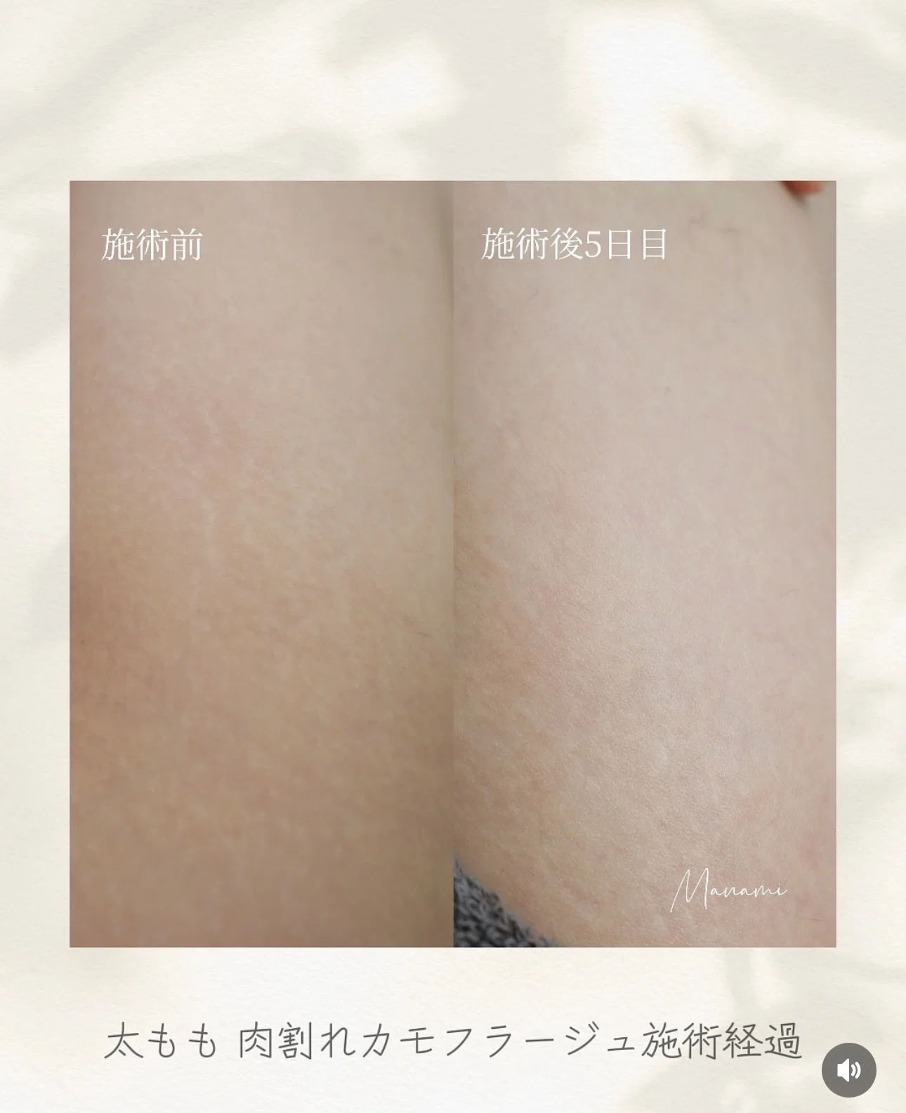 🔸傷跡カモフラージュ（Skin52） / 2回55,000円〜｜仙台アートメイク