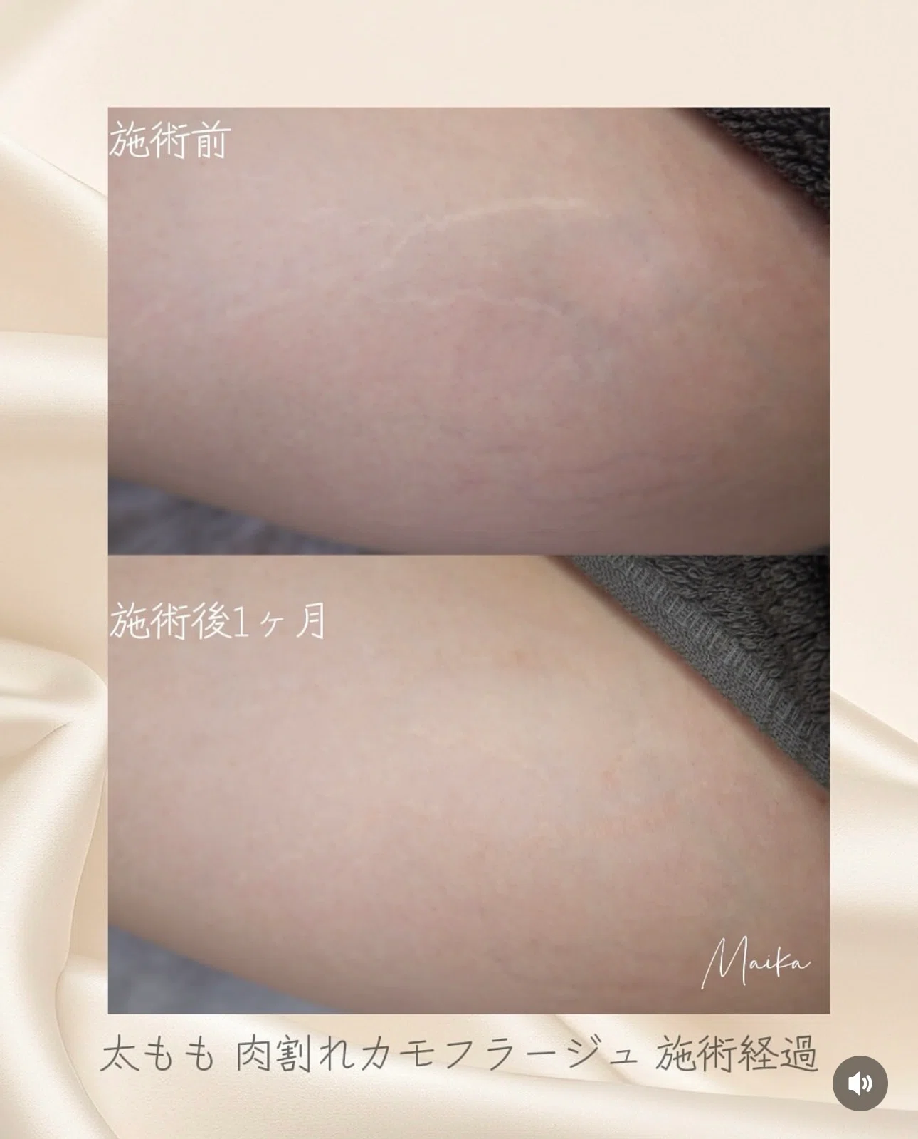 🔸傷跡カモフラージュ（Skin52） / 2回55,000円〜｜仙台アートメイク