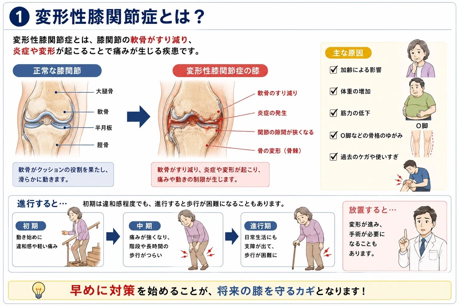 Explained by a Physical Therapist] Knee pain on stairs It might
