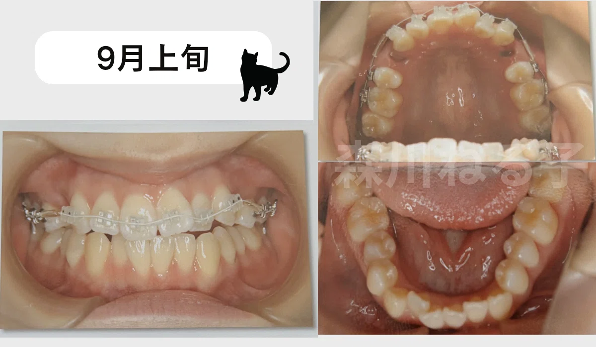 ギシグー 取れない 松風 歯科印象用シリコーン GISHY GOO ギシグー 
