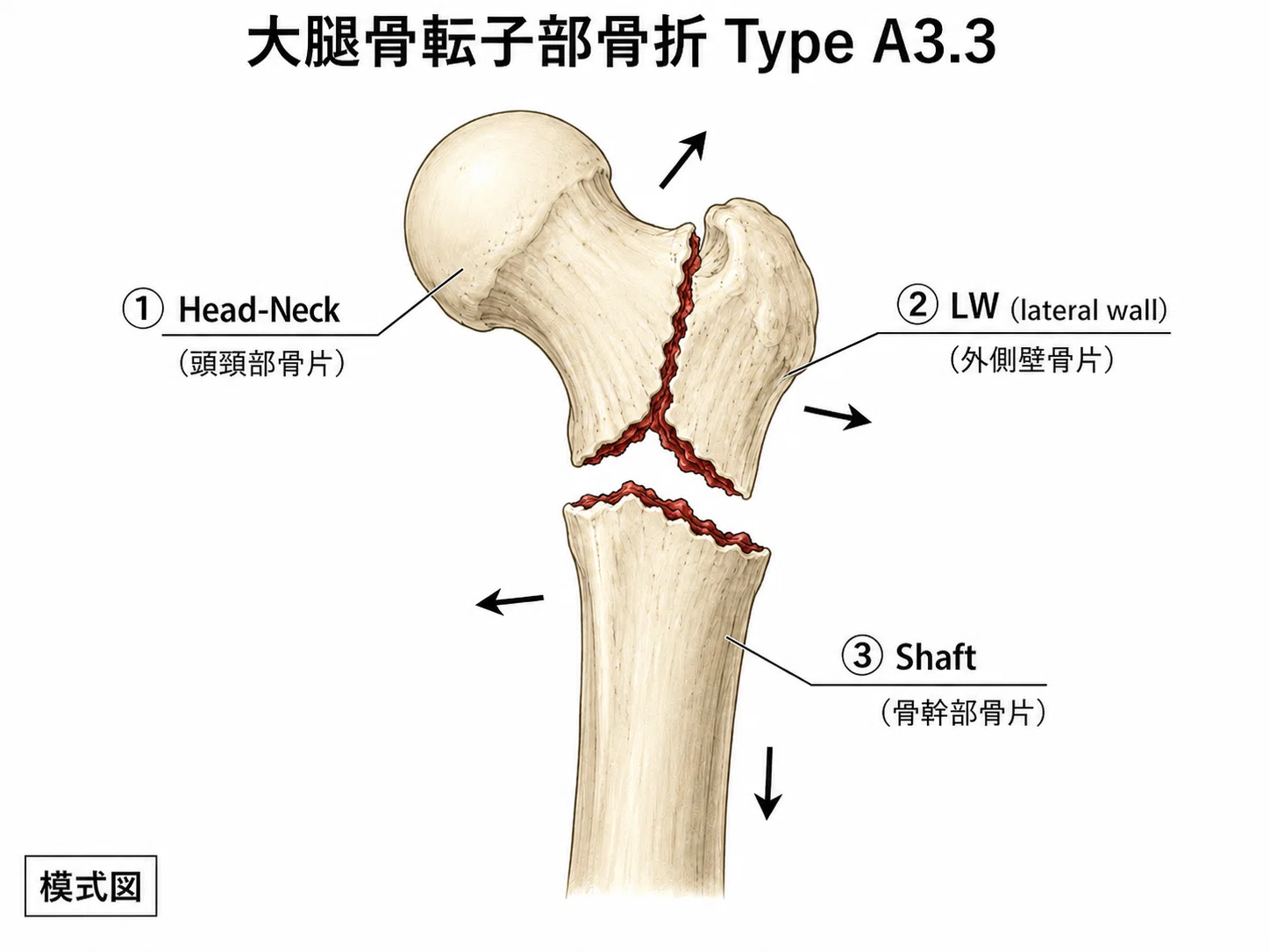 考える外傷整形外科サブノート 29．大腿骨転子部骨折｜生涯学び続け