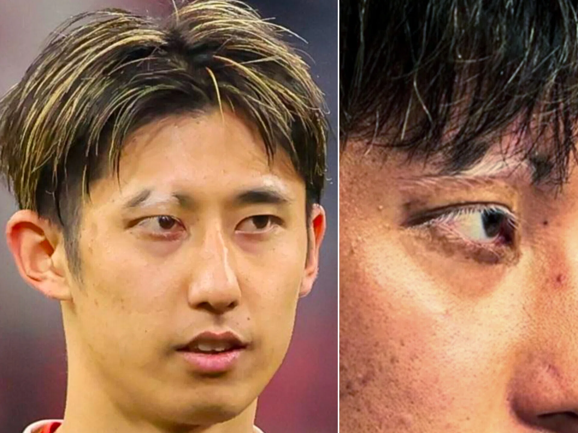 サッカー日本代表 伊藤洋輝選手の眉毛はなぜ白い？尋常性白斑と有名人の活躍／鹿児島 メディカルメイク講師  原口ヒロミ｜原口ヒロミ(原口裕未)│美容介在療法士、メディカルメイク講師│鹿児島＆全国対応