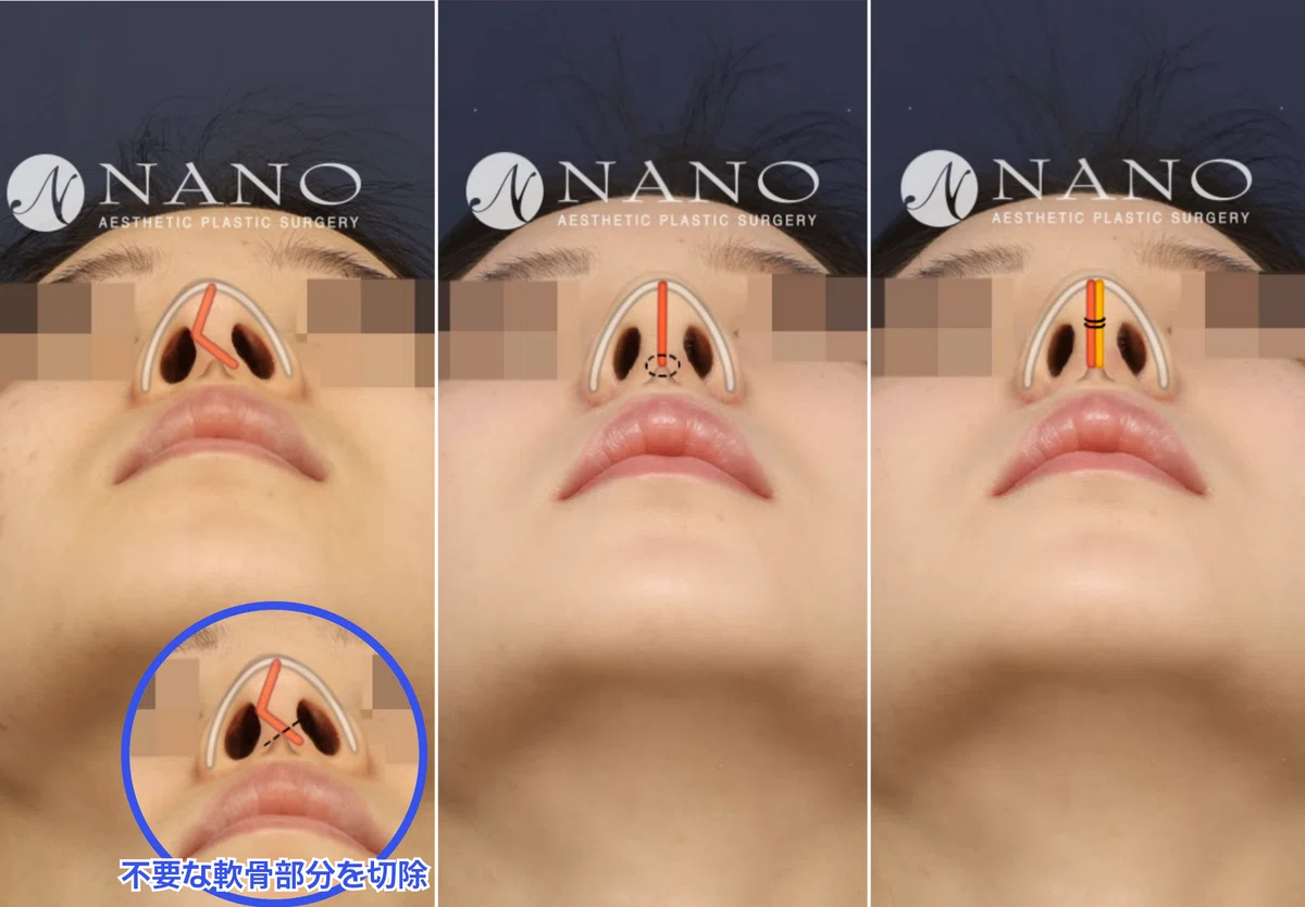 チョ・ジュンヨン院長の手術note #53｜【オーダーメイド鼻専門】ナノ(NANO) 日本公式
