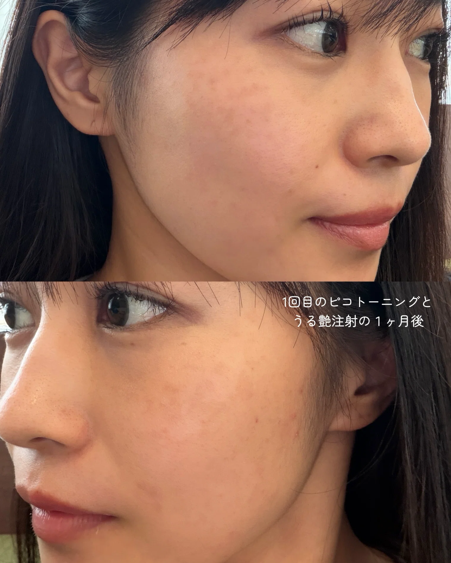 タイ美容】シミ取りレーザーで後悔したくない方へ。私のPIH・肝斑・ADM タイ美容】シミ取りレーザーで後悔したくない方へ。私のPIH・肝斑・ADM