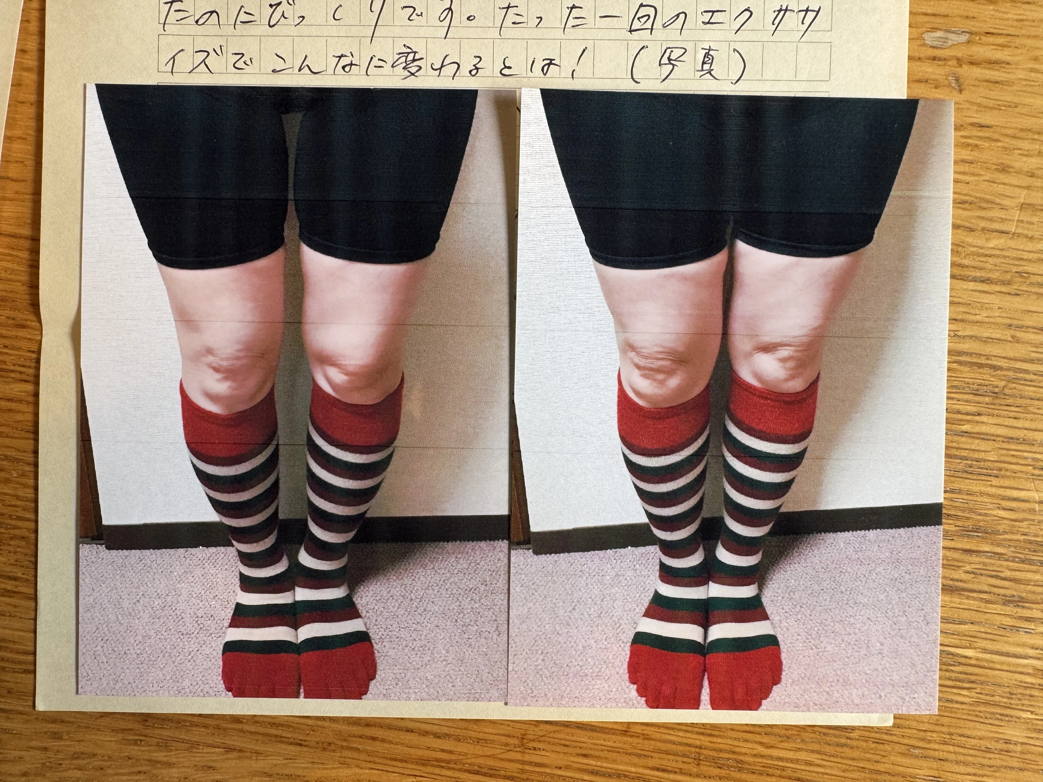 O脚50代女性「先天性の扁平足で、子供の頃からずっとO脚でした。そして