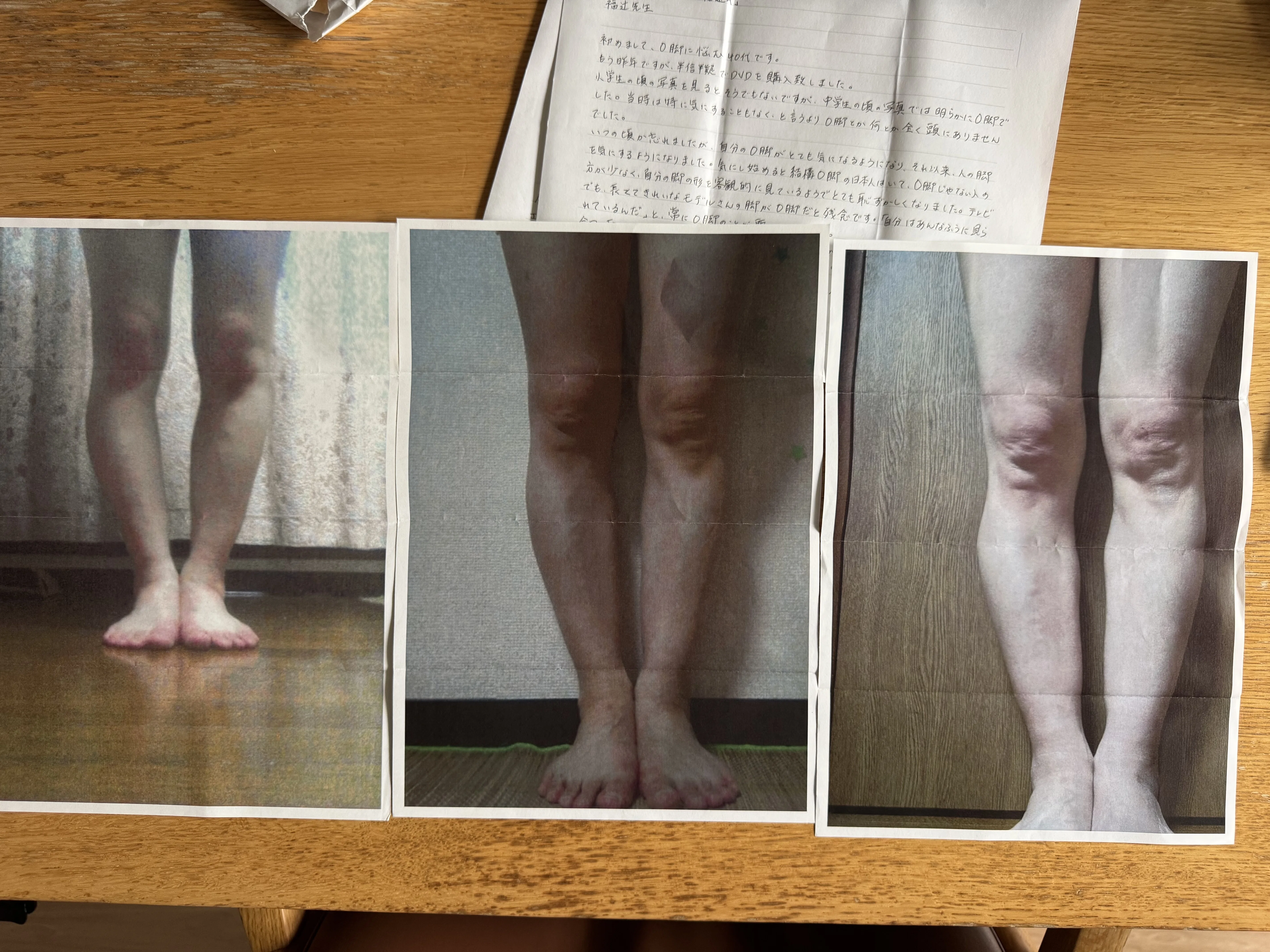 O脚40代女性「気にし始めると結構O脚の日本人はいて、O脚じゃない人の