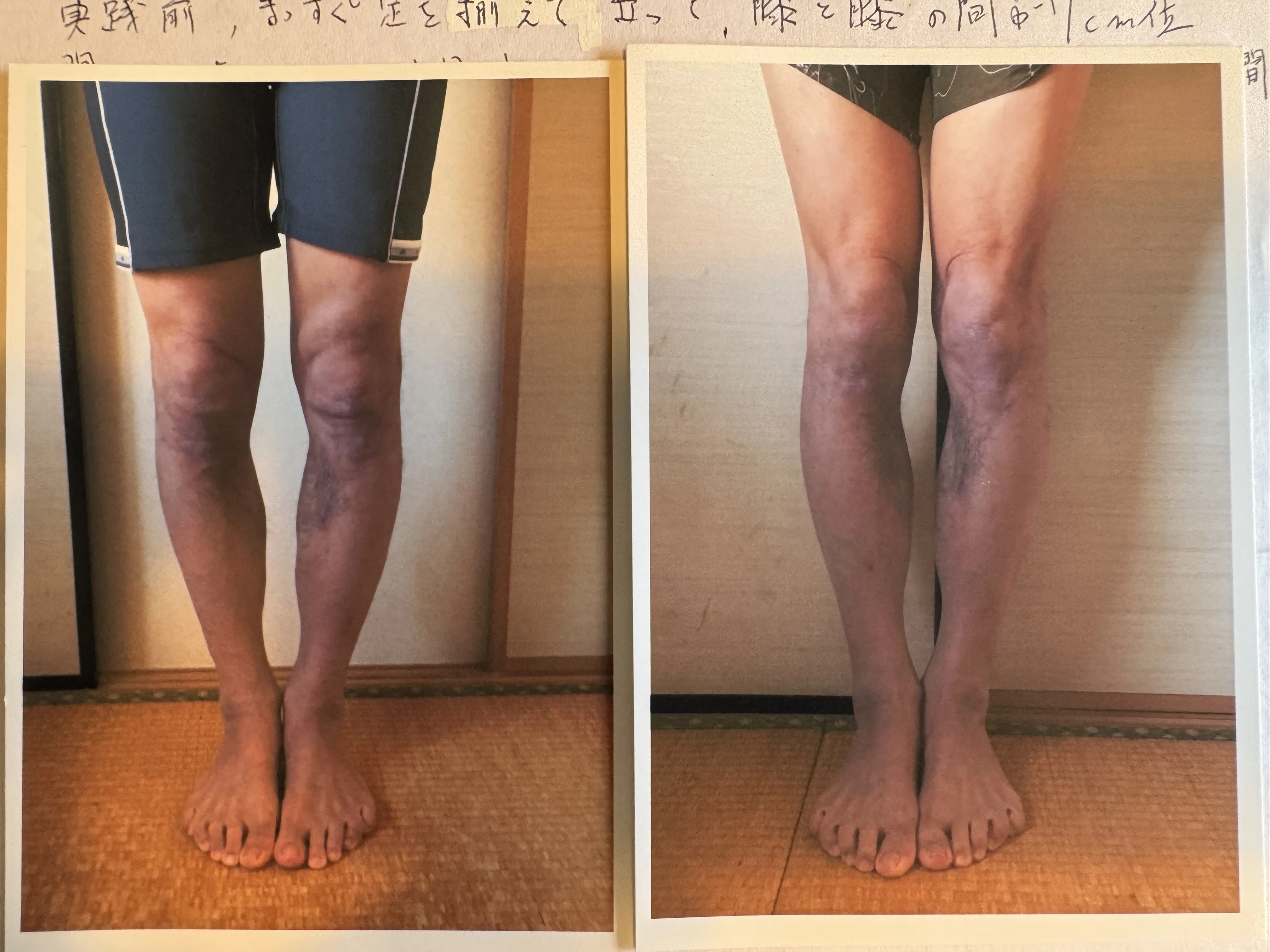 膝下O脚男性「O脚と腰痛は関連があると言う記事がたくさんありました