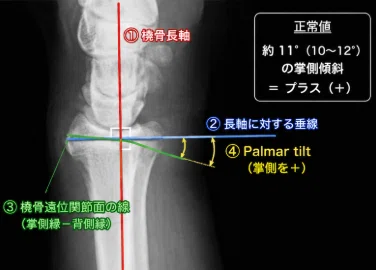 専攻医(整形外科)』橈骨遠位端骨折🦴概論＆ORIF｜せいけ医LV.3