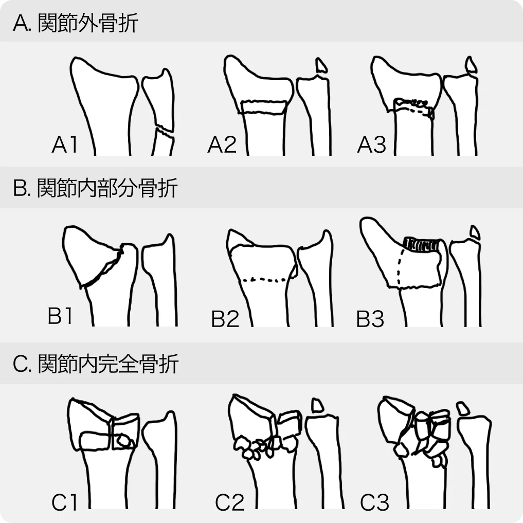 専攻医(整形外科)』橈骨遠位端骨折🦴概論＆ORIF｜せいけ医LV.3