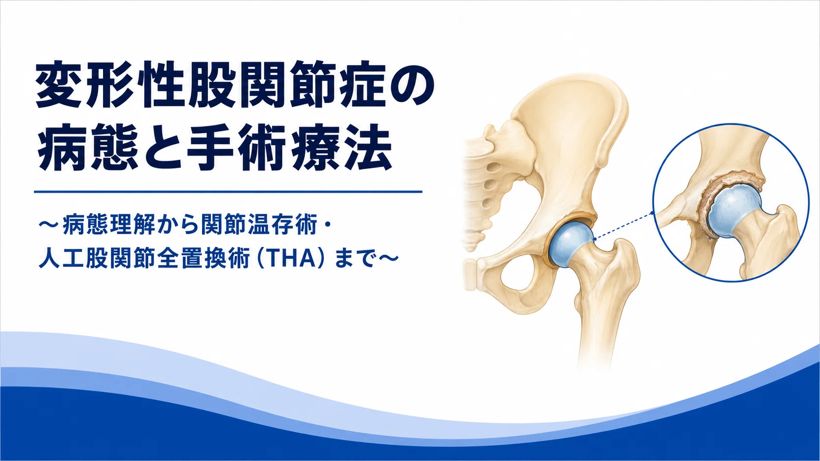 変形性股関節症の評価・理学療法・手術療法完全ガイド― 病態理解から
