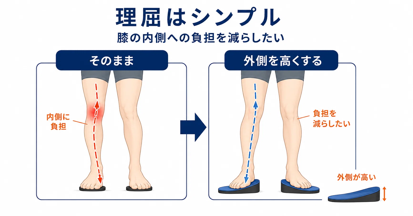 変形性膝関節症のインソール、今の正解は？ガイドラインを調べ直しま