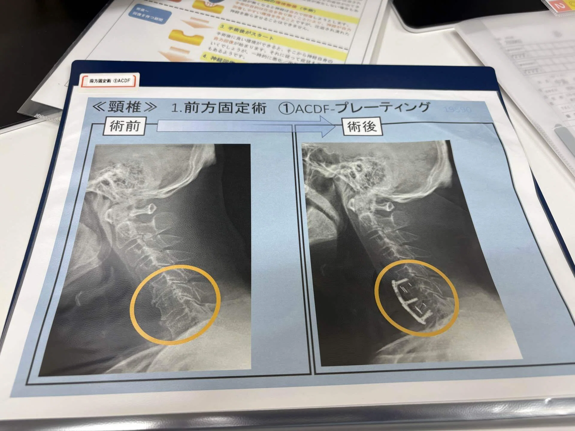 病院めぐりと手術の決定-頸椎椎間板ヘルニア体験談【闘病記②