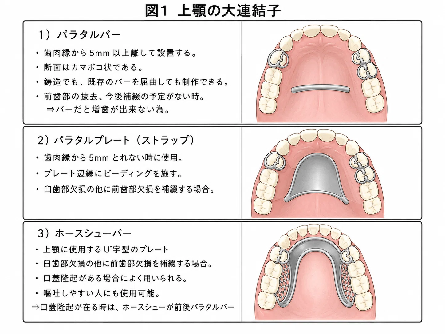 歯科国試対策・部分床義歯】大連結子を完全整理！種類・選択基準・二次