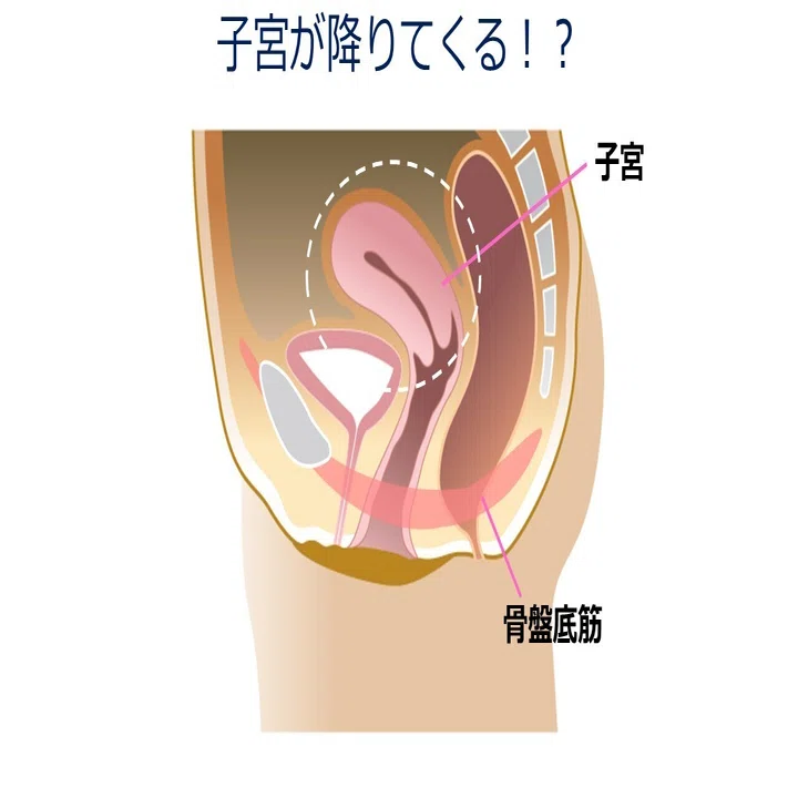 子宮 が 降り て くる