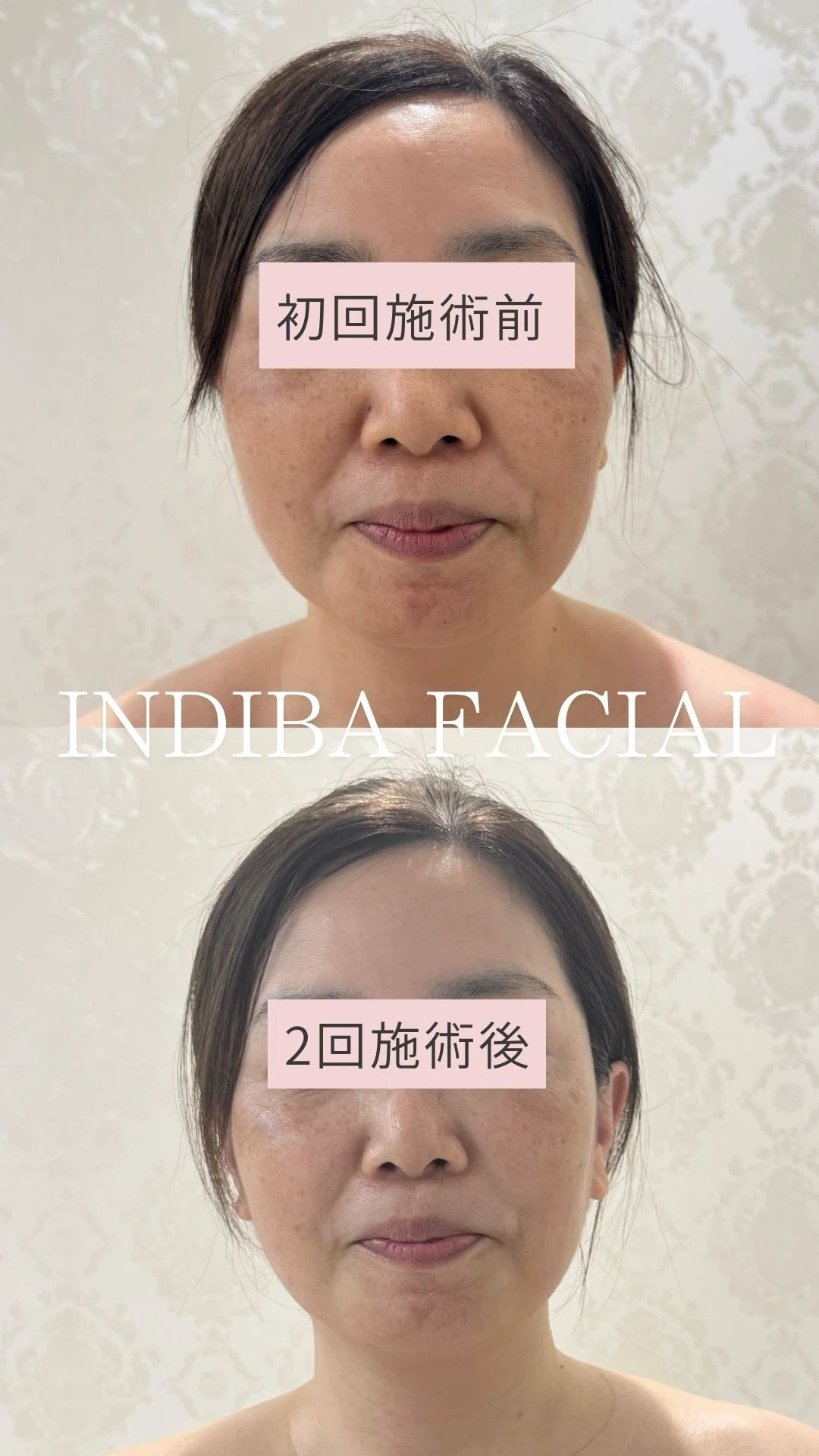インディバフェイシャル6個 インディバフェイシャル6個 速攻小顔