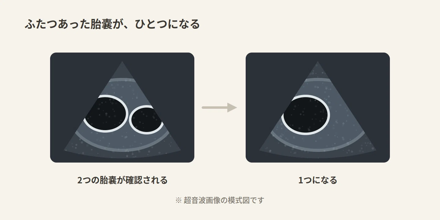 バニシング ツイン と は