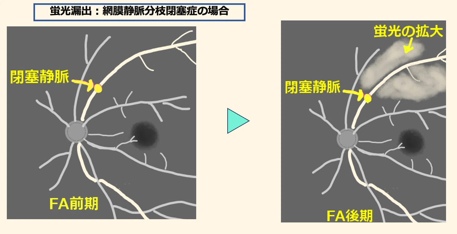 蛍光眼底造影検査（FA・IA）の基礎と読影・病態のまとめ｜眼科医エスロト