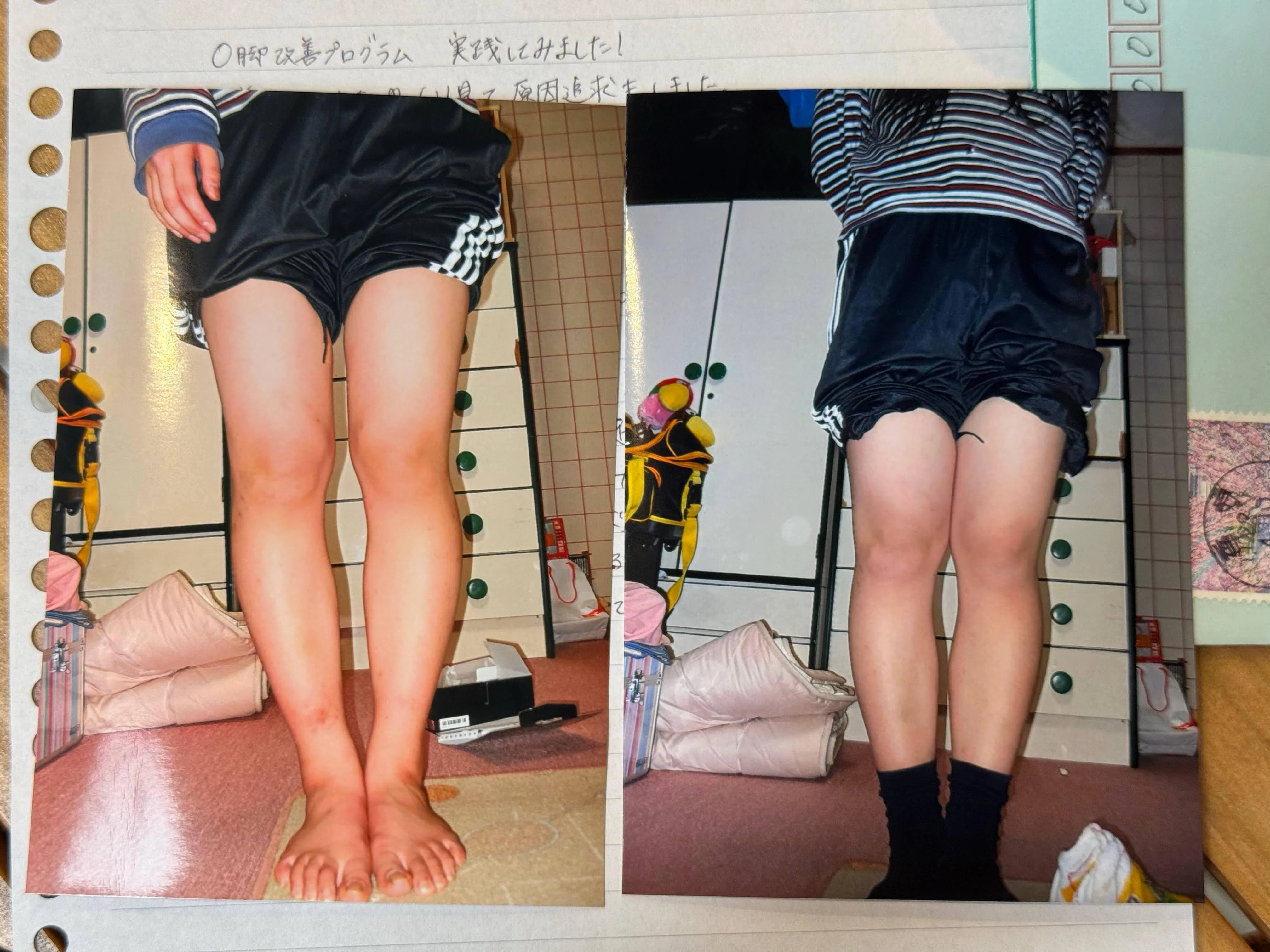 o脚矯正プログラム　「福辻式」 膝下O脚「元々O脚と膝下のO脚で膝下のO脚の存在すら知らなかった｜施術