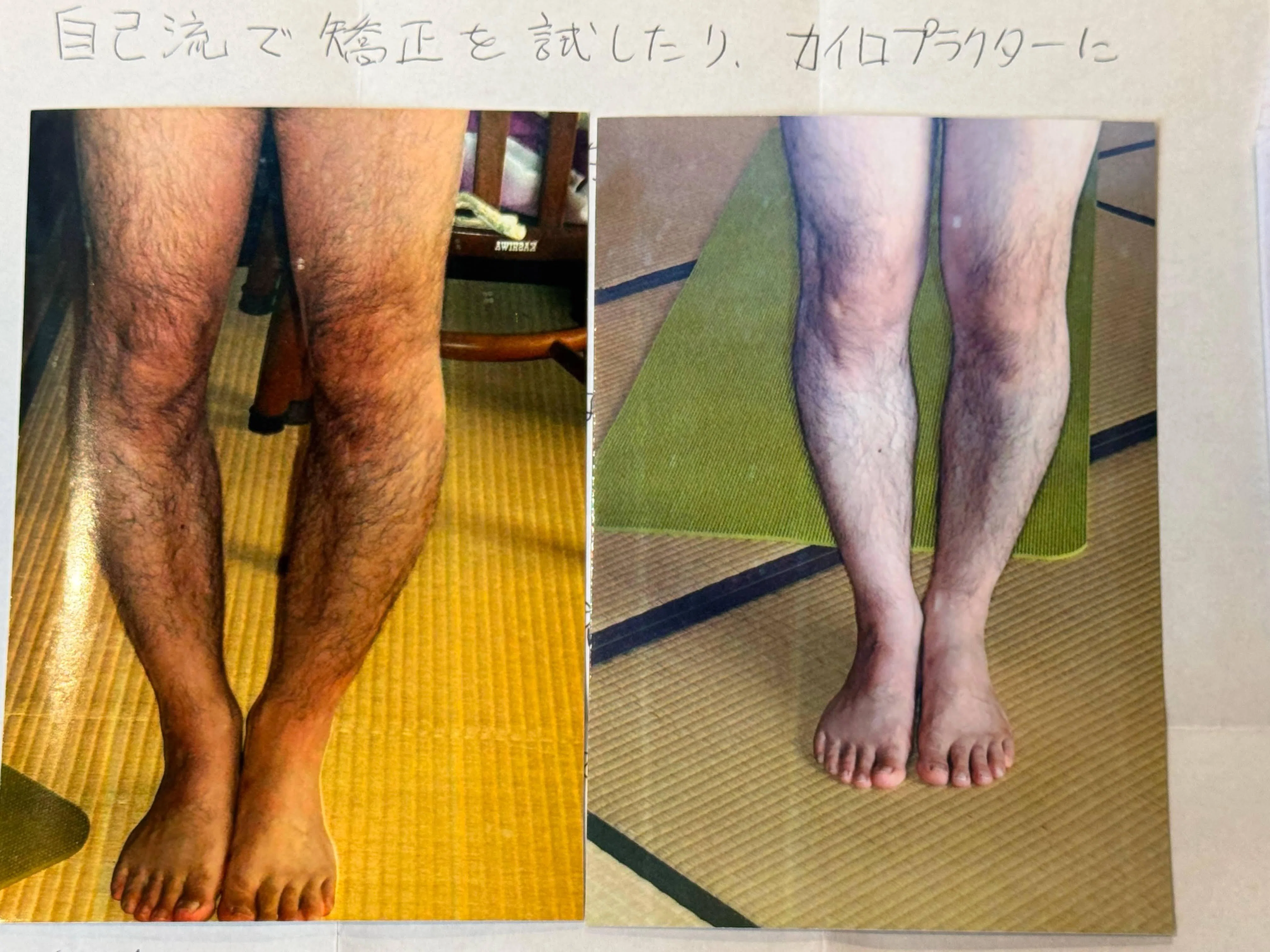 O脚男性「自分のO脚はひどすぎるので治らないのだろうと諦めていました