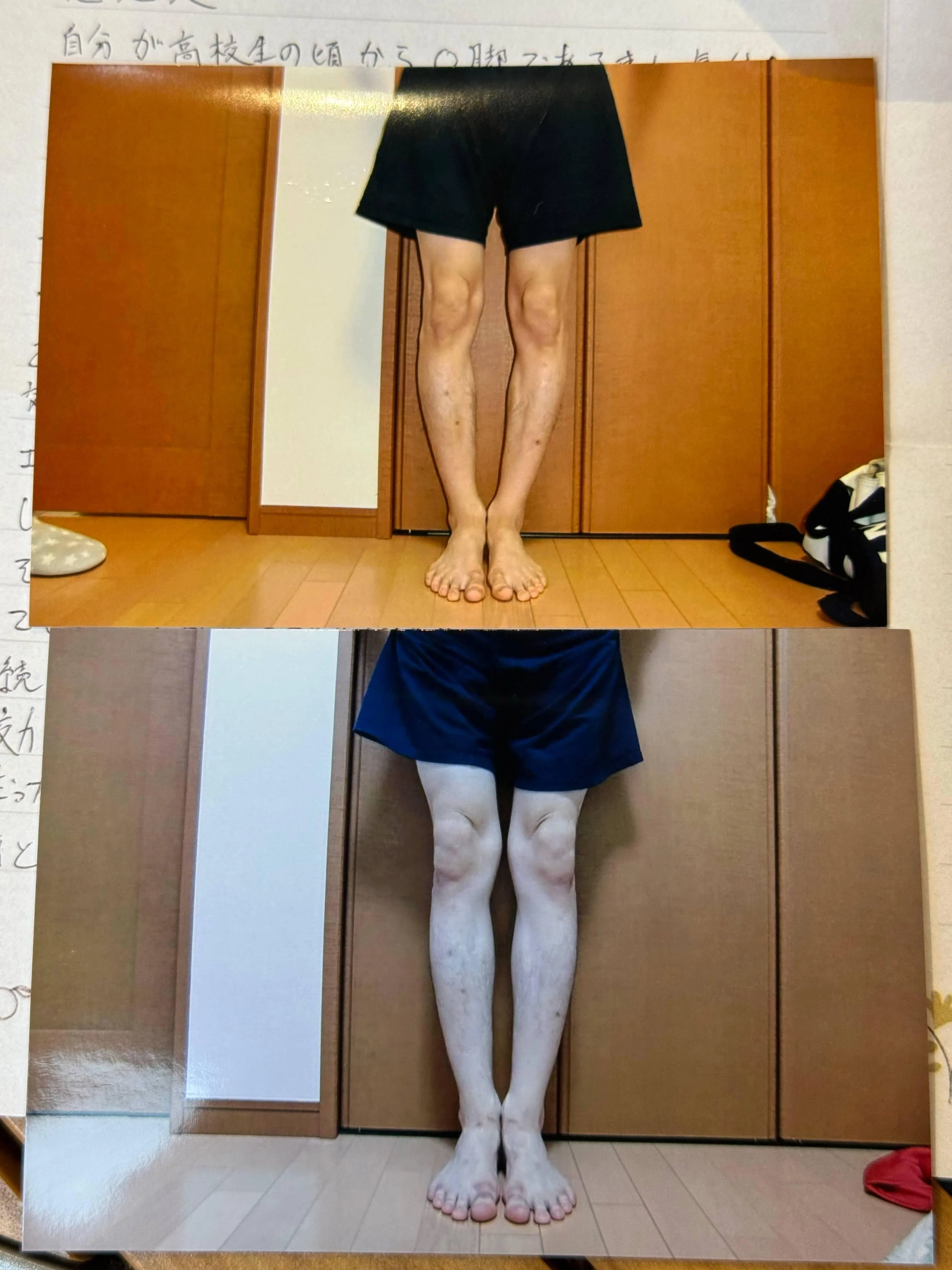 O脚男性「整体に通い、骨盤矯正を試してみましたが、さほど効果われず