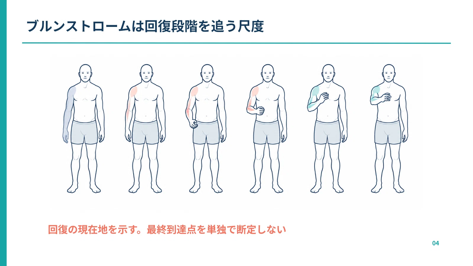 脳卒中の予後予測を臨床につなげる―ブルンストローム・NIHSS・CT血腫量