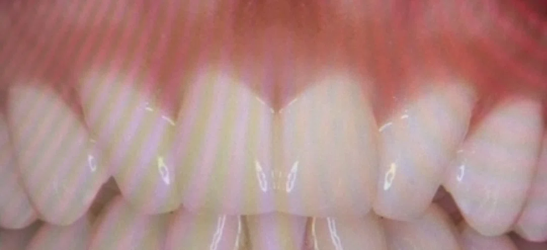 #8 Extract two front teeth for orthodontics? Or implants? What is ...