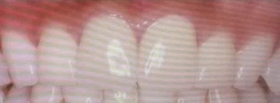 #8 Extract two front teeth for orthodontics? Or implants? What is ...