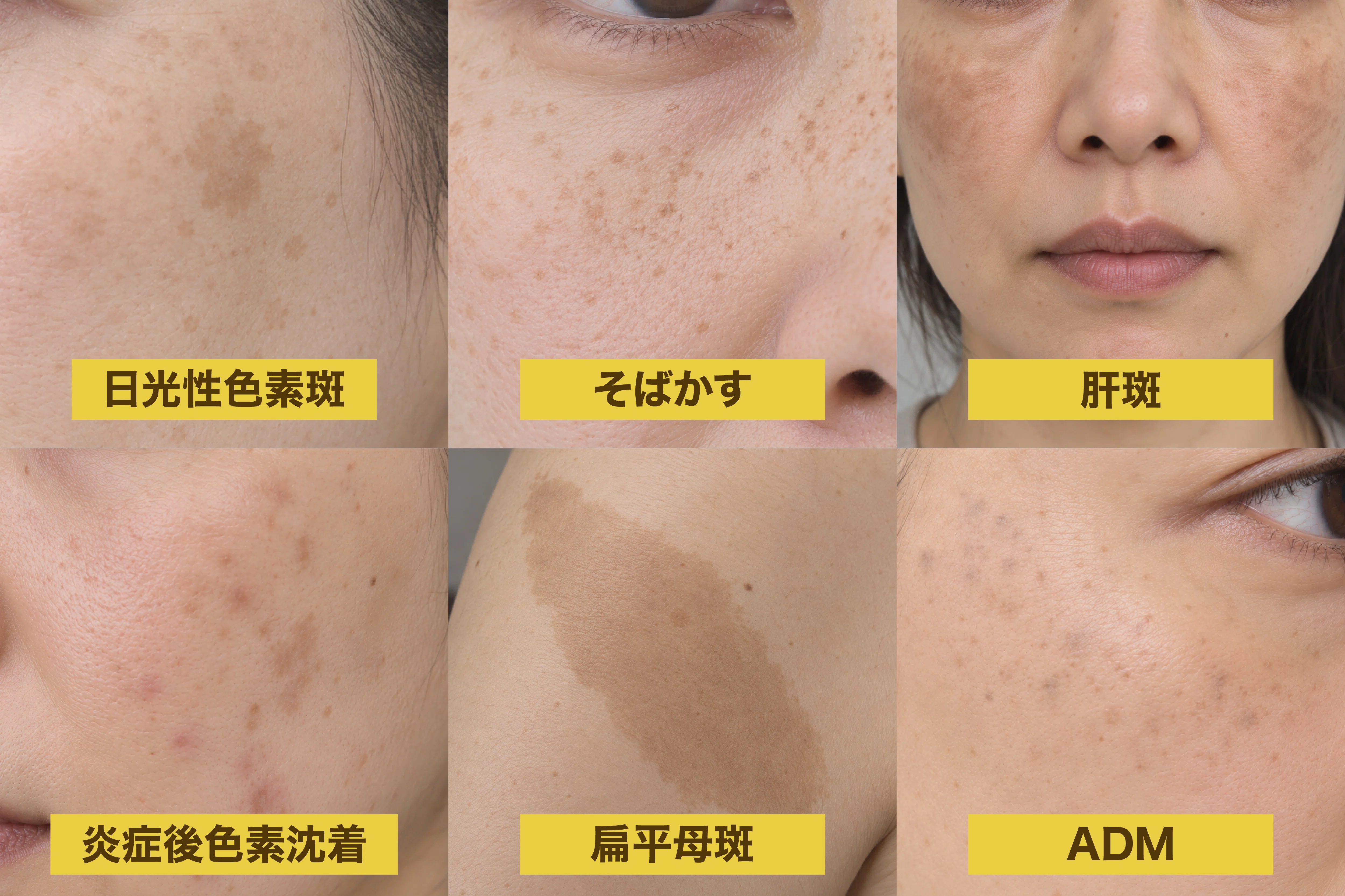 Recommendations for Pione-style Spot Removal Treatment☆｜ピオーネビューティークリニック