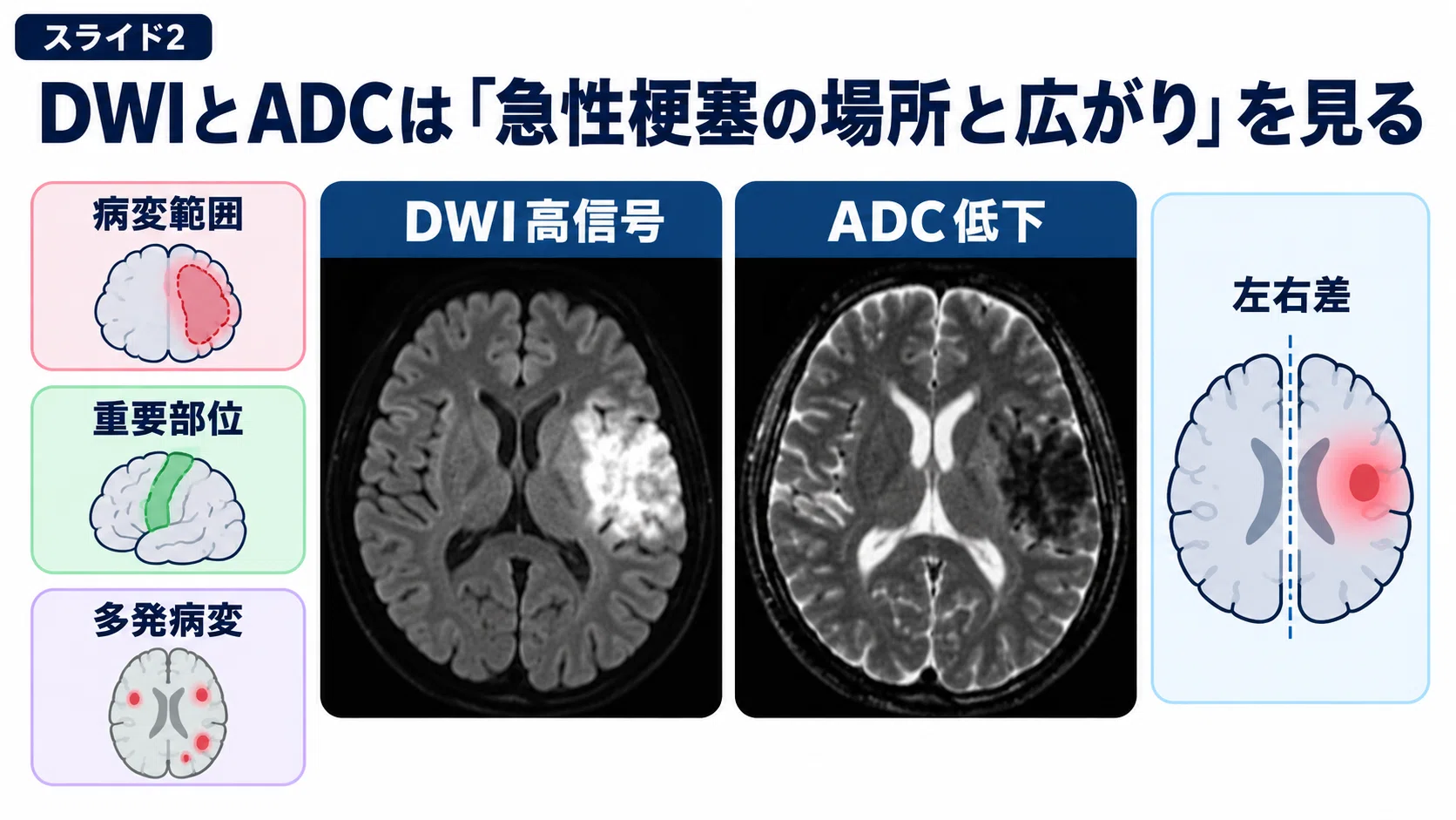 脳卒中、脳画像3点セット 脳卒中MRIの見方｜理学療法士のための脳画像×離床リスク管理【DWI