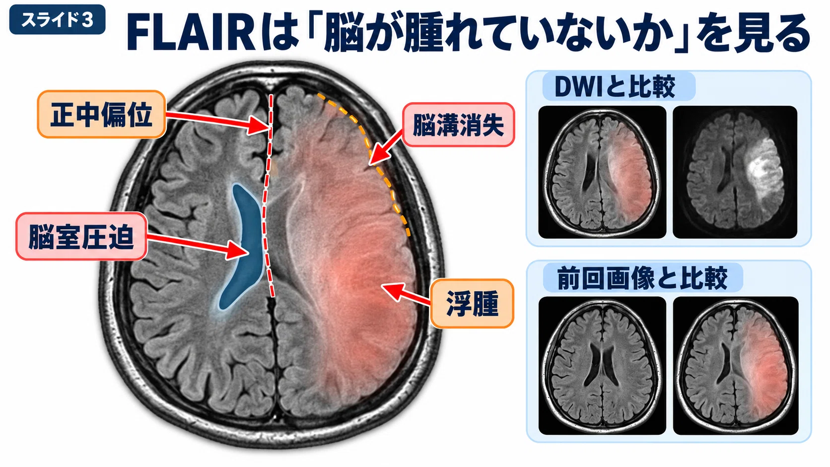 脳卒中MRIの見方｜理学療法士のための脳画像×離床リスク管理【DWI