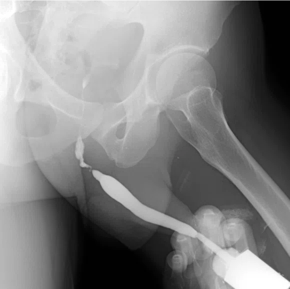 [Textbook of Urethral Stricture Part 147] Thinking Process for Surgical ...