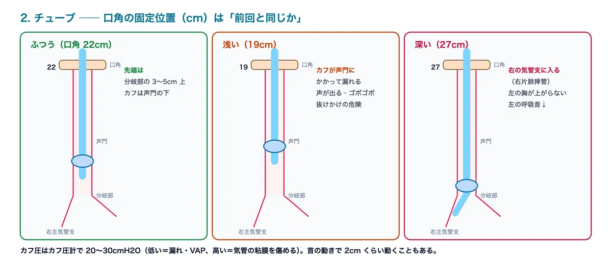 [Ventilator 0-4] Systematic Bedside Check: A Pattern for Tracing the ...