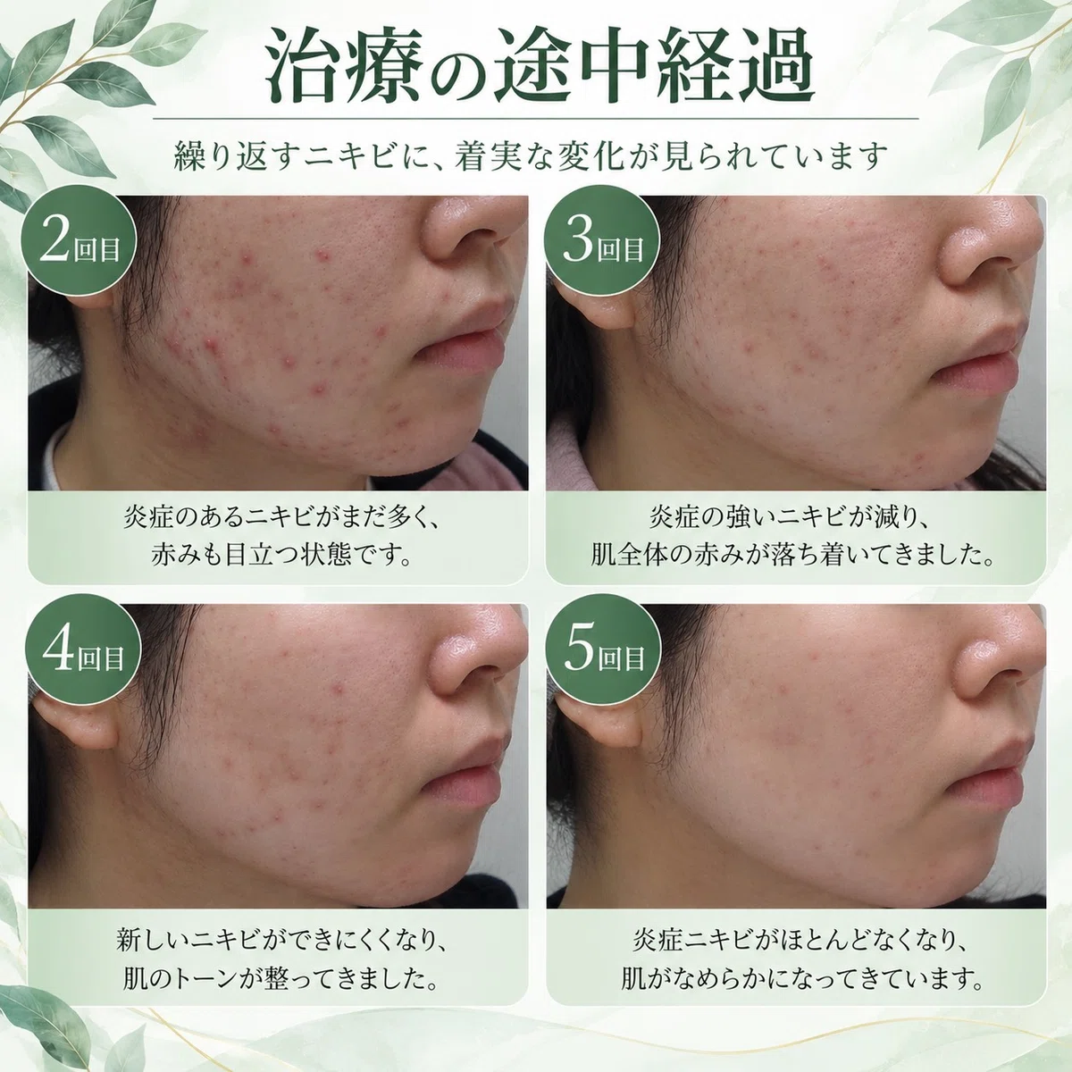 [Case Study] Recurrent acne since junior high school. See how skin that ...