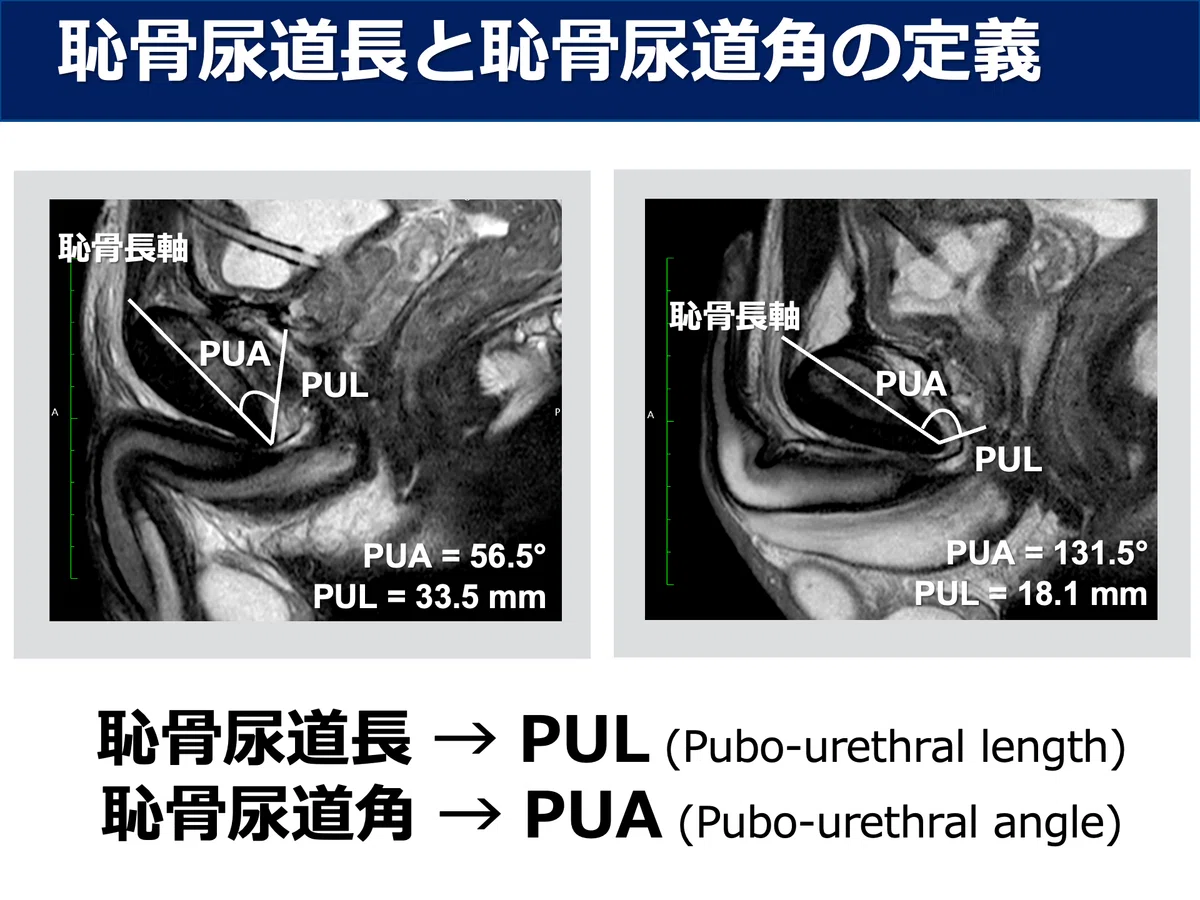 [Textbook of Urethral Stricture Part 150] Diagnosis of Urethral ...