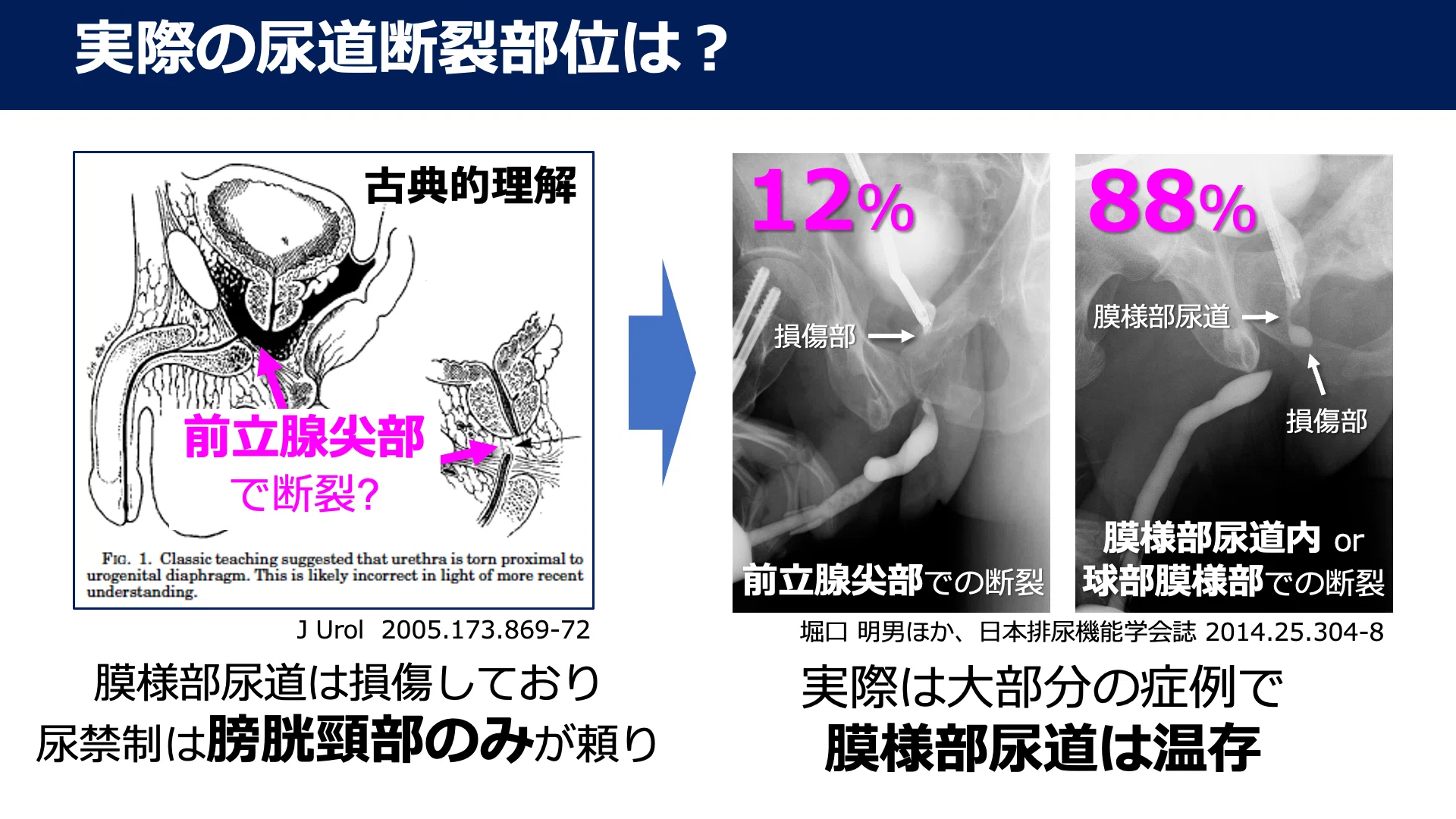[Textbook of Urethral Stricture Part 151] Diagnosis of Urethral ...