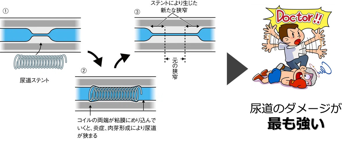[Textbook of Urethral Stricture Part 153] Why Stents Are Not ...