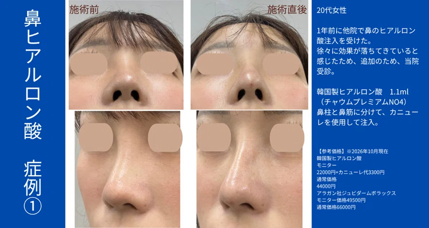 [Achieve an Ideal Profile Without Surgery] Get a Beautiful Nose with ...