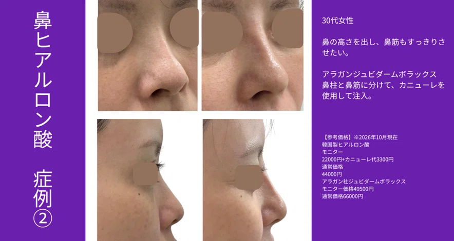 [Achieve an Ideal Profile Without Surgery] Get a Beautiful Nose with ...