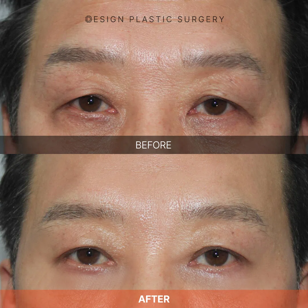 [Case Photos Included] Fight the Signs of Aging from the Root! Regain ...