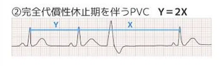 [ECG] Reliably Reading PVCs (Premature Ventricular Contractions): From ...