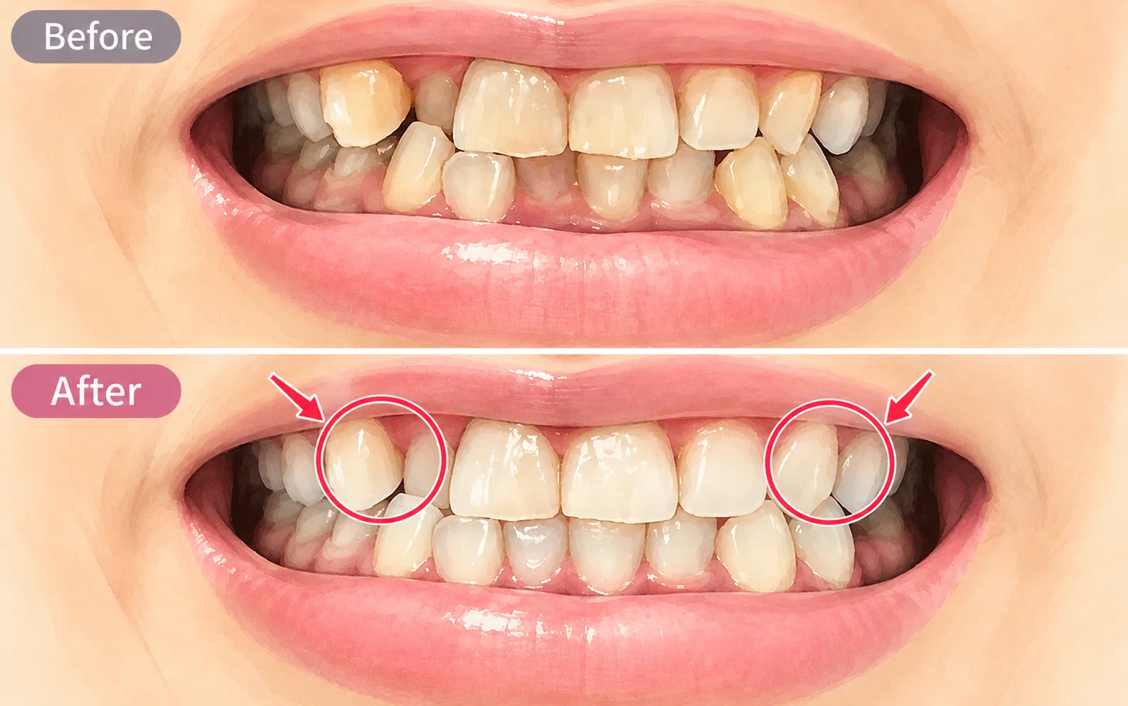 In my 50s, I started dental correction (Invisalign) ⑩｜Fumi⭐︎