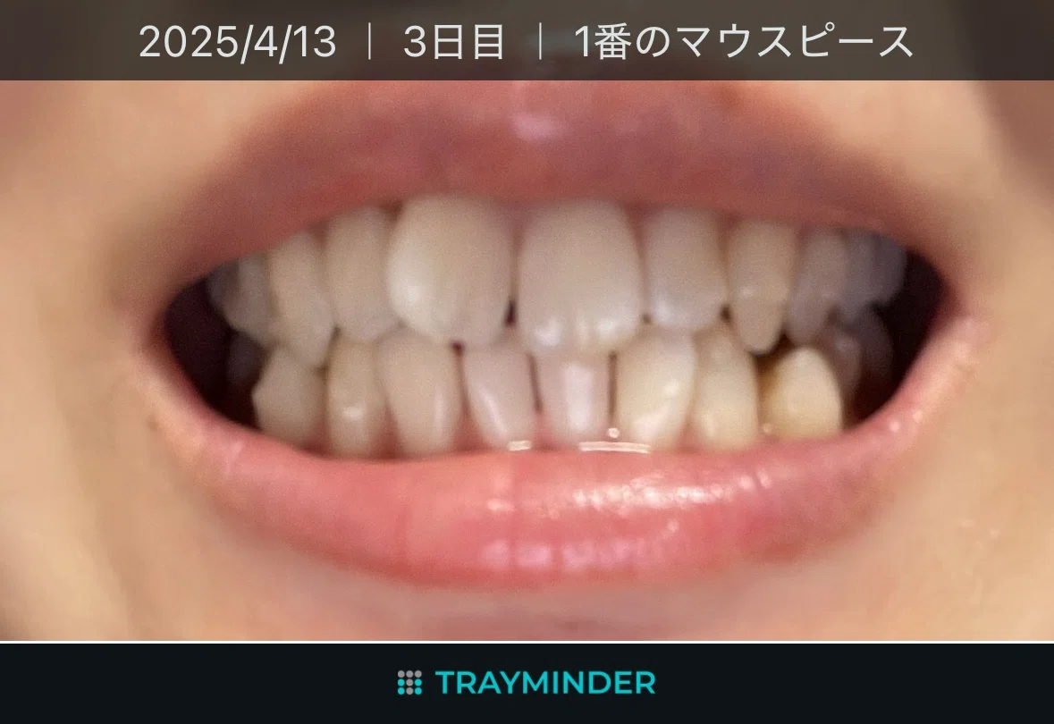 [With Photos] Invisalign Progress: How Much My Teeth Changed in 4 ...