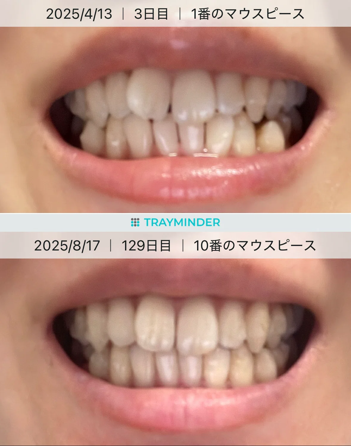 [With Photos] Invisalign Progress: How Much My Teeth Changed in 4 ...