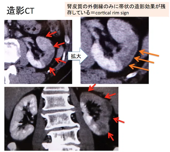 Renal infarction is not visible on plain CT | Wedge-shaped defects on ...
