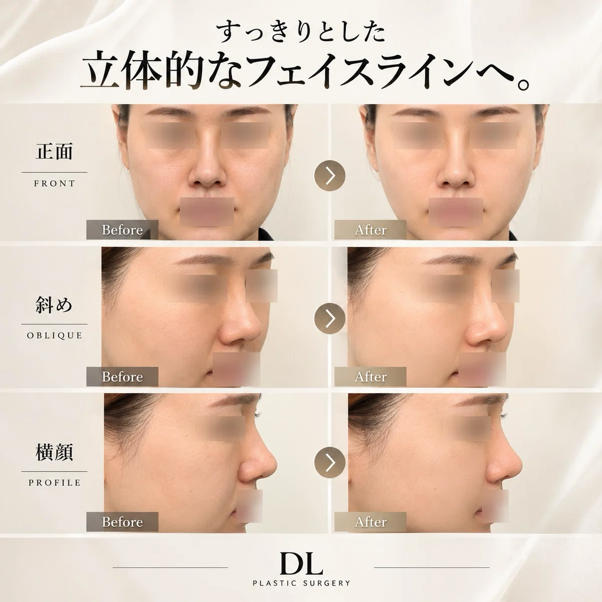[Korean 3-Point Facial Contouring] How do the cheekbones, jawline, and ...