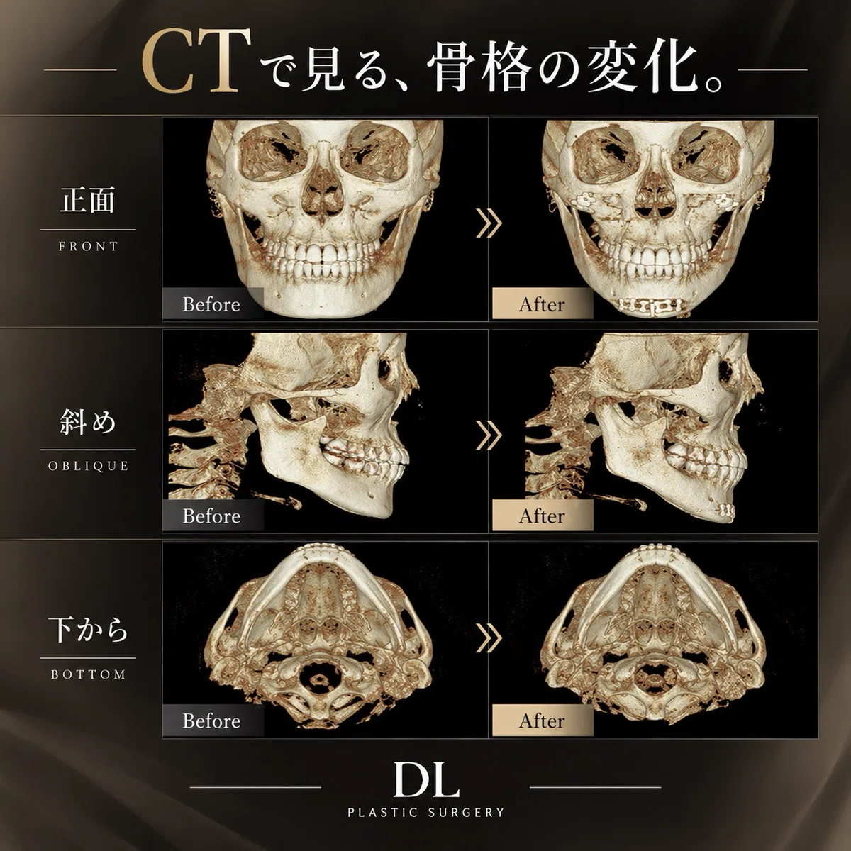 [Korean 3-Point Facial Contouring] How do the cheekbones, jawline, and ...