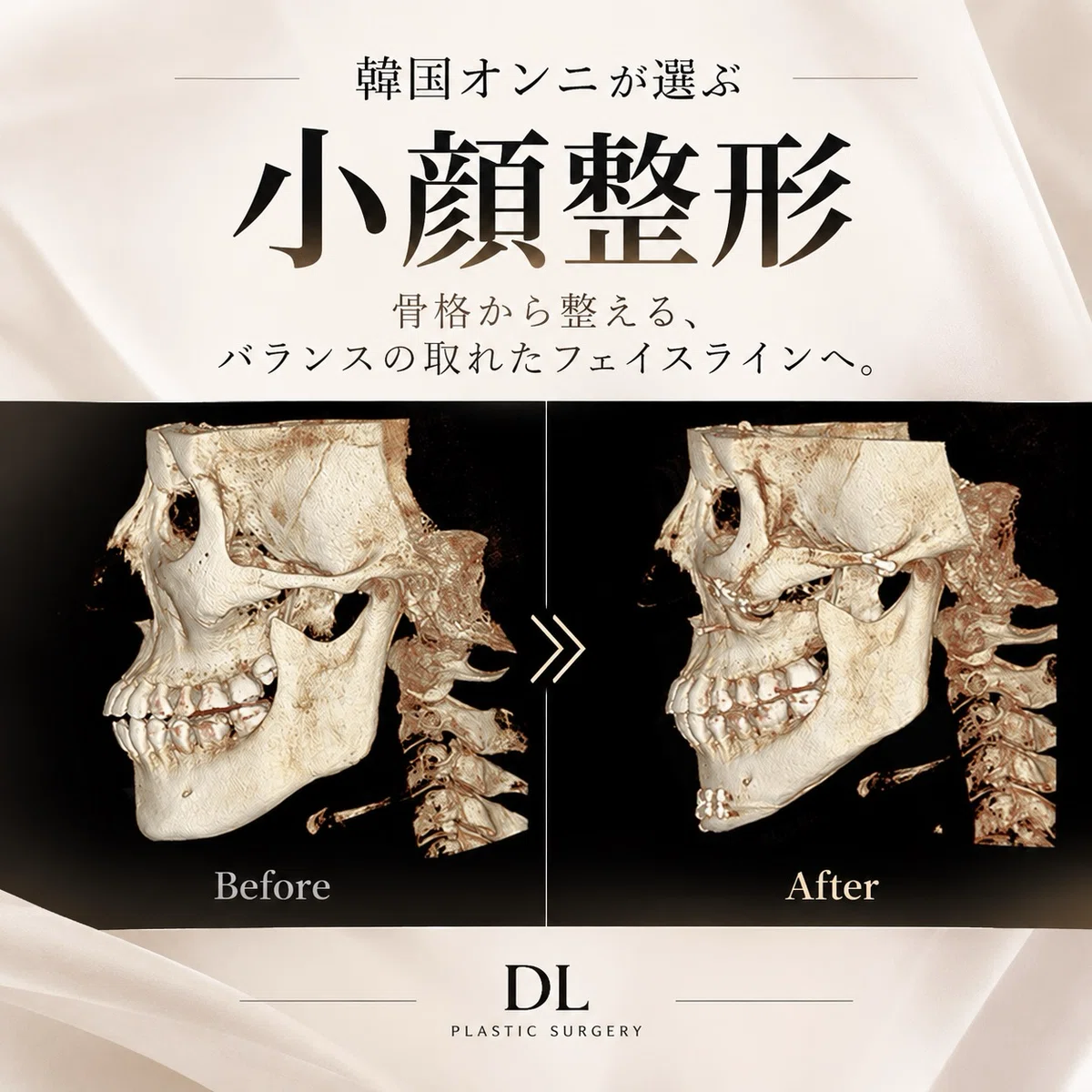 [Korean 3-Point Facial Contouring] How do the cheekbones, jawline, and ...