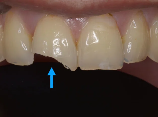 [Dentist Explains] Sharp pain from cold things! The 5 major causes and ...